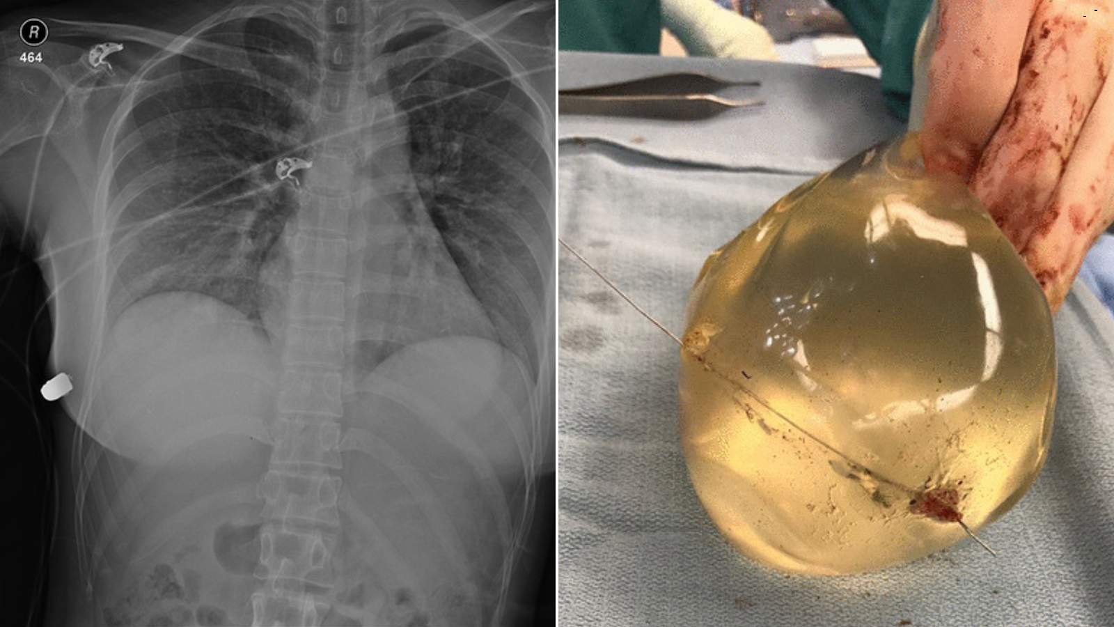 Woman’s breast implant deflects bullet, saving her life